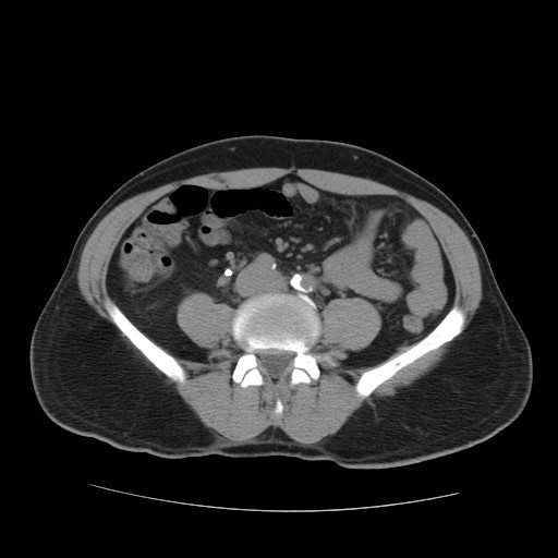 File:Obstructed kidney with perinephric urinoma (Radiopaedia 26889-27067 Axial non-contrast 3).jpg