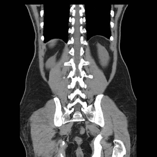 File:Obstructed kidney with perinephric urinoma (Radiopaedia 26889-27067 Coronal non-contrast 26).jpg