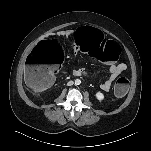 File:Obstructing sigmoid adenocarcinoma (Radiopaedia 58465-65619 A 87).jpg