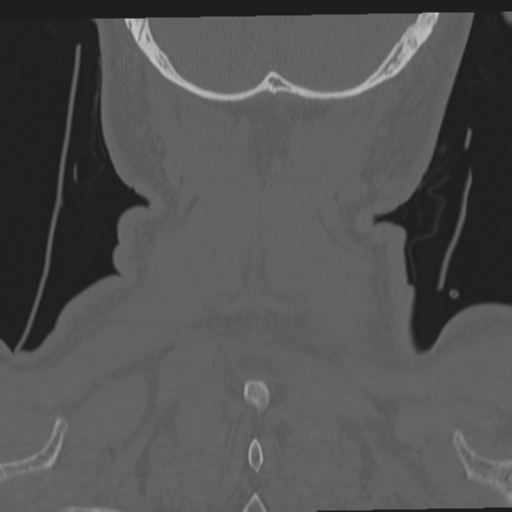 File:Occipital condyle fracture (Radiopaedia 33467-34517 Coronal bone window 67).png