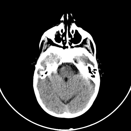 Occipital encephalocele (Radiopaedia 87339-103636 Axial non-contrast 28).jpg