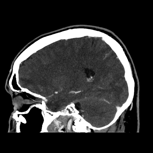 Occipital extradural hematoma simulating venous sinus thrombosis (Radiopaedia 46514-50964 D 50).jpg