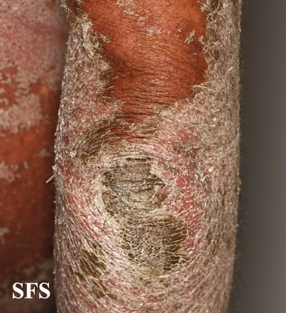 File:Psoriasis (Dermatology Atlas 78).jpg