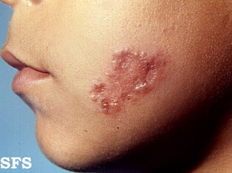 File:Sarcoidosis (Dermatology Atlas 1).jpg