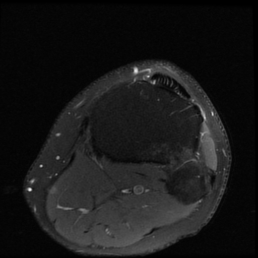 File:ACL and meniscal tears (Radiopaedia 79604-92797 Axial PD fat sat 22).jpg