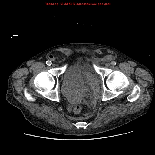 File:Abdominal aortic aneurysm- extremely large, ruptured (Radiopaedia 19882-19921 Axial C+ arterial phase 74).jpg