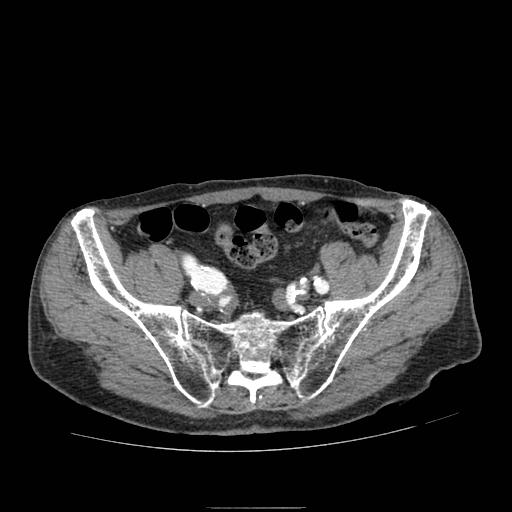 Abdominal aortic aneurysm (Radiopaedia 13341-13340 Axial C+ arterial phase 195).jpg