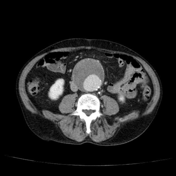 Abdominal aortic aneurysm (Radiopaedia 29248-29660 Axial C+ portal venous phase 35).jpg