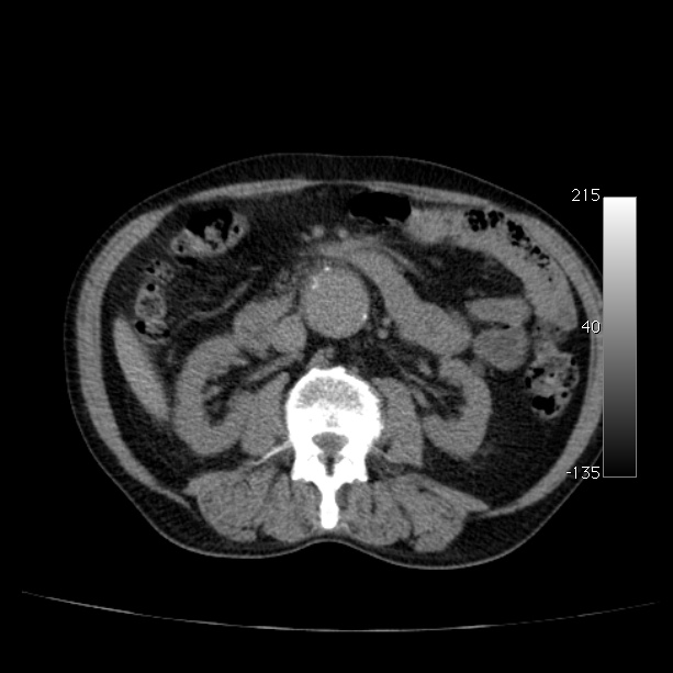 Abdominal aortic aneurysm (Radiopaedia 29248-29660 Axial non-contrast 26).jpg