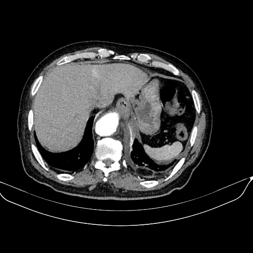 Abdominal aortic aneurysm (Radiopaedia 67117-76452 Axial C+ arterial phase 21).jpg