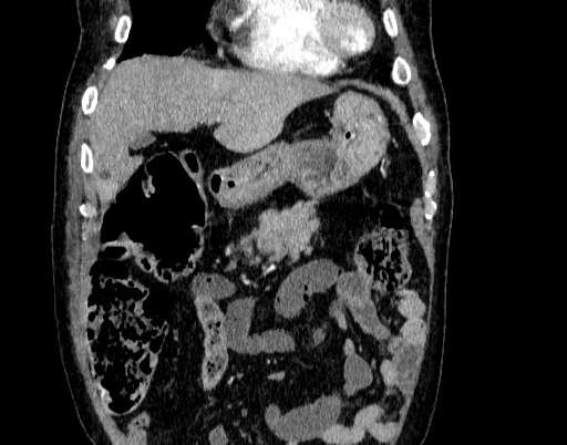 Abdominal aortic aneurysm (Radiopaedia 67117-76452 Coronal C+ arterial phase 11).jpg