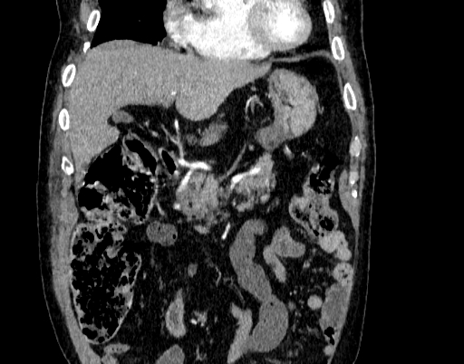 Abdominal aortic aneurysm (Radiopaedia 67117-76452 Coronal C+ arterial phase 16).jpg