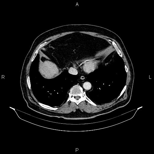 Abdominal aortic aneurysm (Radiopaedia 83094-97462 Axial renal cortical phase 59).jpg
