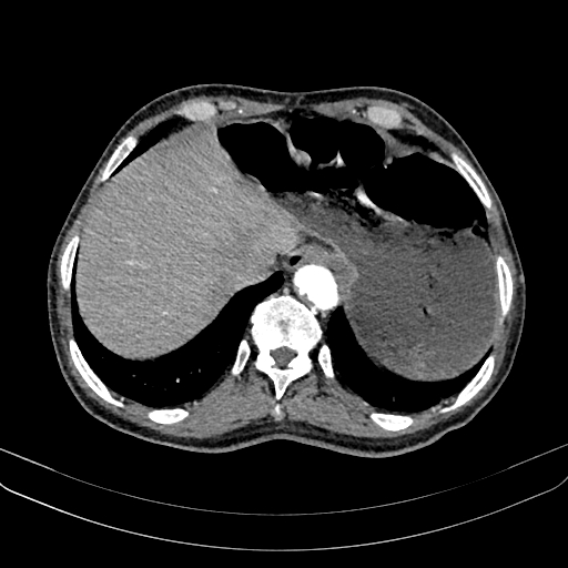Abdominal aortic aneurysm (Radiopaedia 83581-98689 Axial C+ arterial phase 21).jpg
