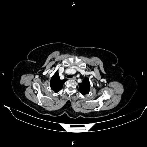 File:Abdominal aortic aneurysm (Radiopaedia 85063-100606 Axial C+ portal venous phase 8).jpg