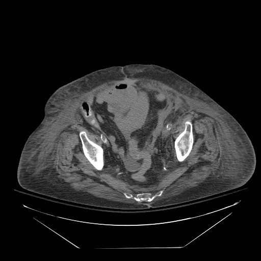 Abdominal aortic aneurysm - impending rupture (Radiopaedia 19233-19247 Axial non-contrast 140).jpg