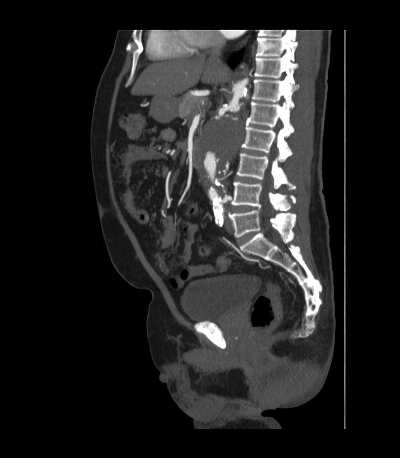 Abdominal aortic aneurysm with thrombus fissuration (Radiopaedia 46218-50618 Sagittal C+ arterial phase 30).jpg