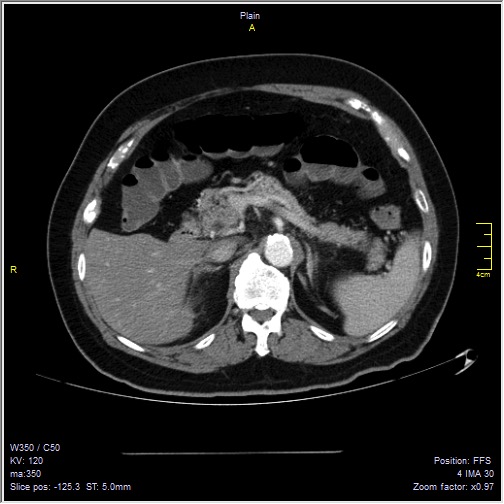 Abdominal aortic aneurysm with thrombus fissuration (Radiopaedia 47340-51926 Axial C+ arterial phase 14).jpg