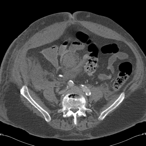 Abdominal hematoma (Radiopaedia 33614-34715 Axial C+ portal venous phase 84).png