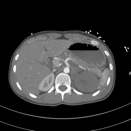 File:Abdominal multi-trauma - devascularised kidney and liver, spleen and pancreatic lacerations (Radiopaedia 34984-36486 Axial C+ arterial phase 93).png