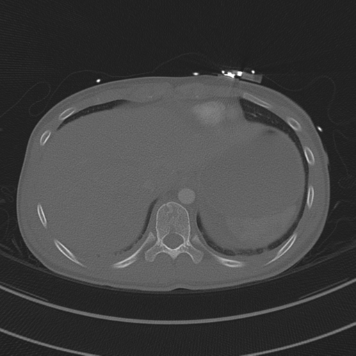 File:Abdominal multi-trauma - devascularised kidney and liver, spleen and pancreatic lacerations (Radiopaedia 34984-36486 I 73).png