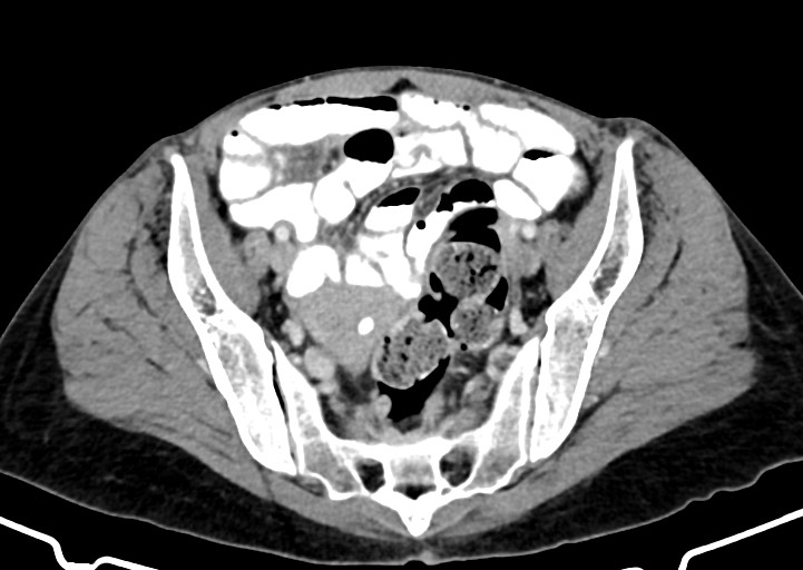Abdominal wall and retroperitoneal tuberculosis (Radiopaedia 88137-104729 Axial C+ portal venous phase 152).jpg
