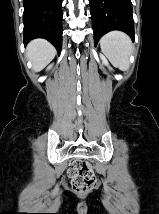 Abdominal wall and retroperitoneal tuberculosis (Radiopaedia 88137-104729 Coronal C+ portal venous phase 85).jpg