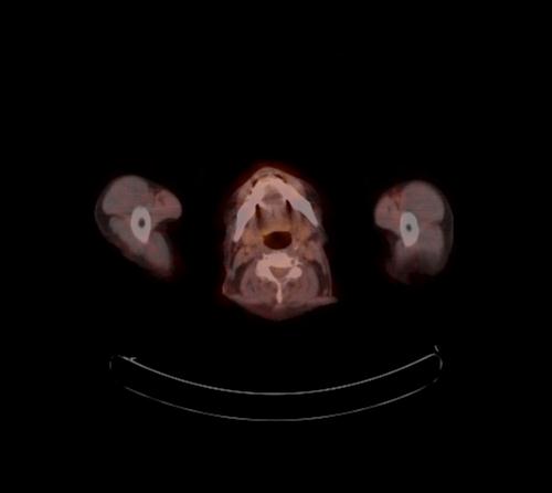 Abdominal wall metastasis from colorectal carcinoma (Radiopaedia 31016-31719 C 141).jpg