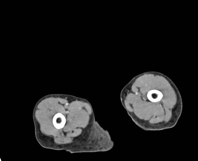 Abdominopelvic rhabdomyosarcoma (Radiopaedia 78356-90984 Axial C+ portal venous phase 176).jpg