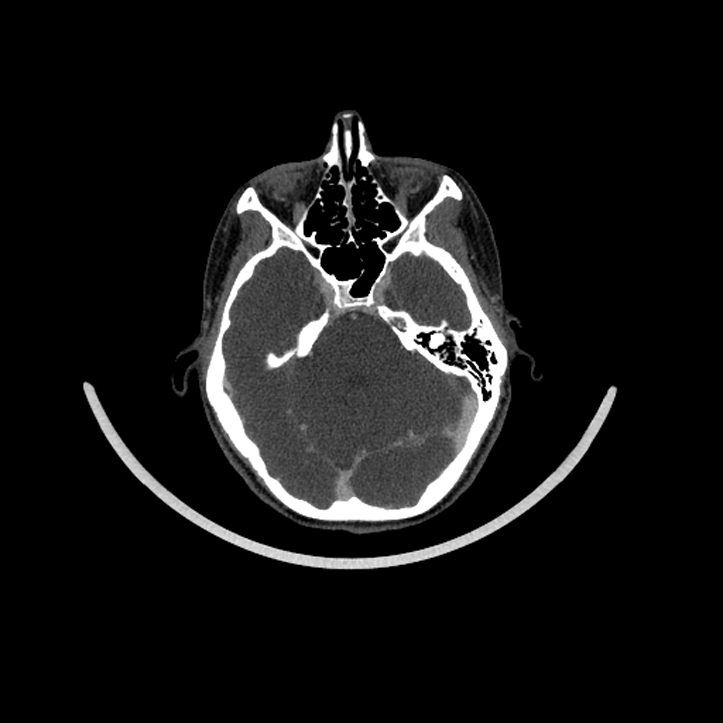 Aberrant right internal carotid artery (Radiopaedia 65191-74197 Axial C+ arterial phase 16).jpg