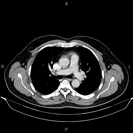 File:Aberrant right subclavian artery (Radiopaedia 87093-103354 Axial With contrast 47).jpg