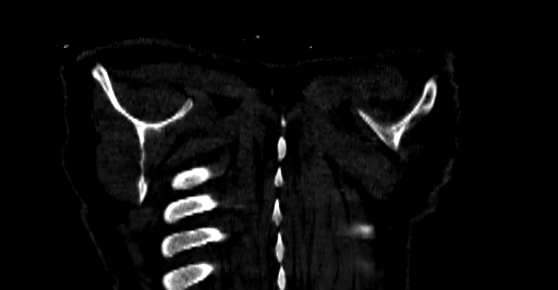 Accesory rib joint (Radiopaedia 71987-82452 Coronal bone window 92).jpg