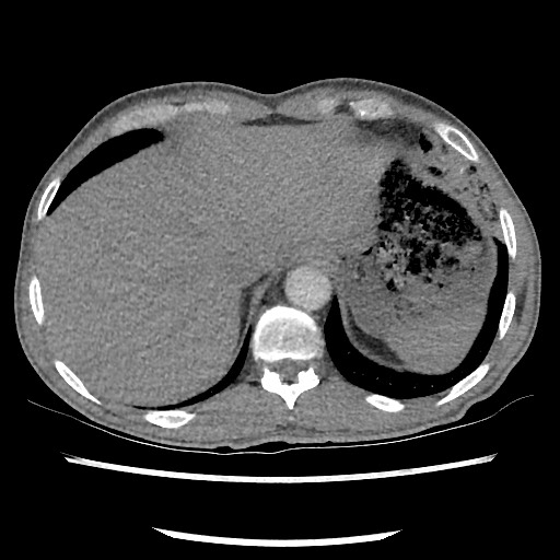 Accessory left horizontal fissure with lingular pneumonia (Radiopaedia 53763-59843 Axial C+ CTPA 79).jpg