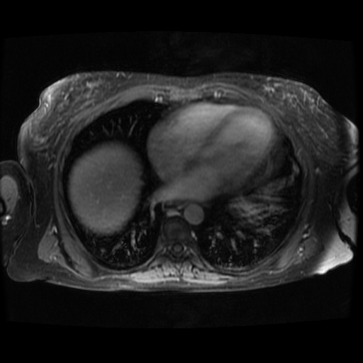 Acinar cell carcinoma of the pancreas (Radiopaedia 75442-86668 Axial T1 C+ fat sat 141).jpg