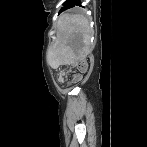 Acinar cell carcinoma of the pancreas (Radiopaedia 75442-86669 Sagittal C+ portal venous phase 168).jpg