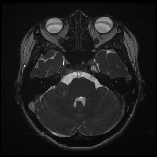 File:Acoustic neuroma (Radiopaedia 34049-35283 Axial 63).png