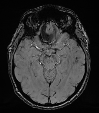 File:Acoustic schwannoma (Radiopaedia 50846-56358 Axial SWI 39).png