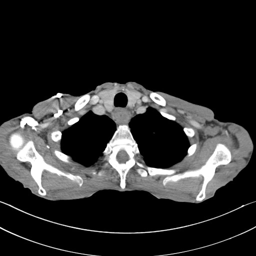 File:Acquired tracheoesophageal fistula (Radiopaedia 57747-65042 Axial C+ portal venous phase 10).jpg