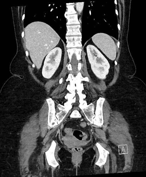 Active Crohn disease (Radiopaedia 59394-66750 Coronal C+ portal venous phase 51).jpg