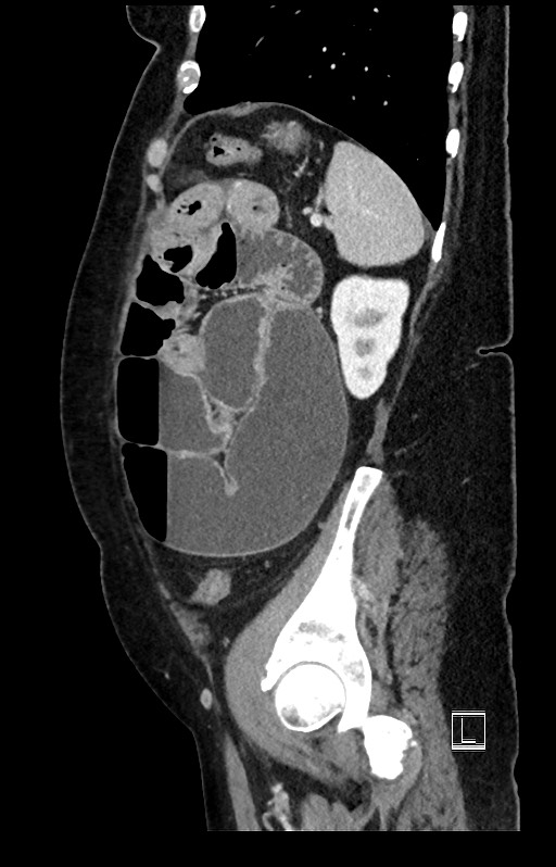 Active Crohn disease (Radiopaedia 59394-66750 Sagittal C+ portal venous phase 14).jpg
