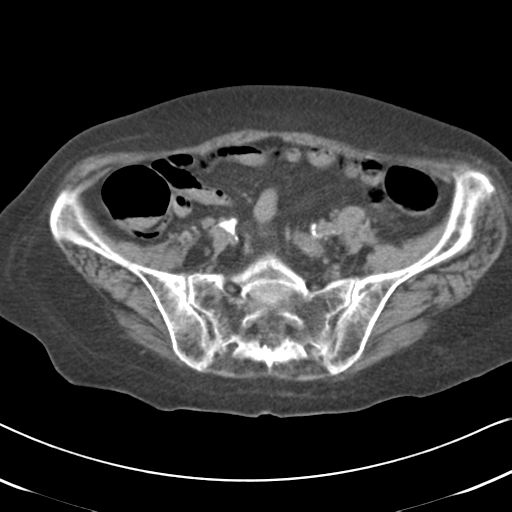 File:Active bleeding from duodenal ulcer with embolization (Radiopaedia 34216-35481 Axial non-contrast 47).png