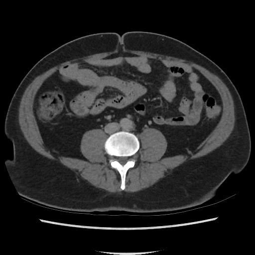 File:Active colonic bleed on CT (Radiopaedia 49765-55025 Axial C+ delayed 49).jpg