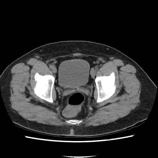 Active colonic bleed on CT (Radiopaedia 49765-55025 Axial non-contrast 76).jpg