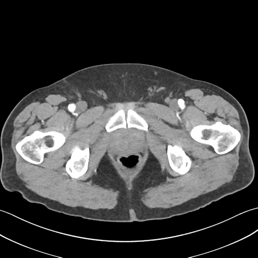 File:Active diverticular hemorrhage (Radiopaedia 39415-41725 Axial C+ arterial phase 73).png