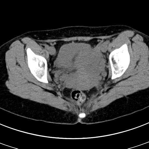 Acute appendicitis (Radiopaedia 30261-30888 Axial non-contrast 97).jpg