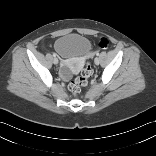 Acute appendicitis (Radiopaedia 30297-30934 Axial C+ portal venous phase 68).jpg