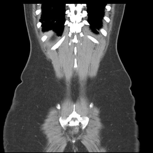 File:Acute appendicitis (Radiopaedia 30297-30934 Coronal C+ portal venous phase 42).jpg