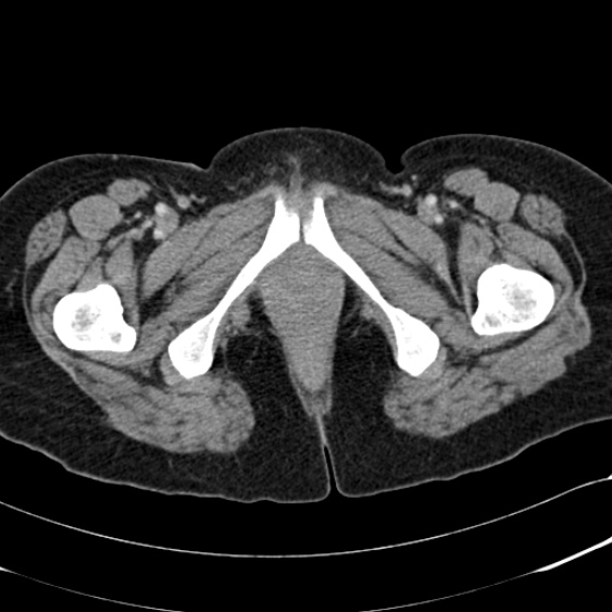 Acute appendicitis (Radiopaedia 48792-53822 Axial C+ portal venous phase 127).jpg