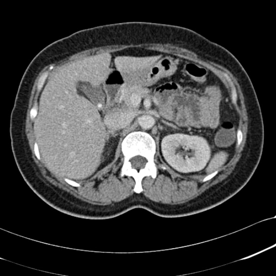File:Acute appendicitis (Radiopaedia 48792-53822 Axial C+ portal venous phase 35).jpg