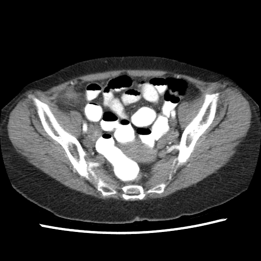 File:Acute appendicitis (Radiopaedia 52672-58589 Axial C+ arterial phase 23).jpg